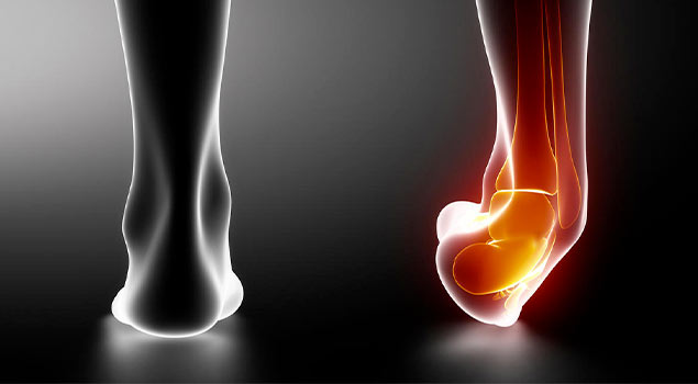 Entorse de la cheville : comment la soigner ? | Ranna